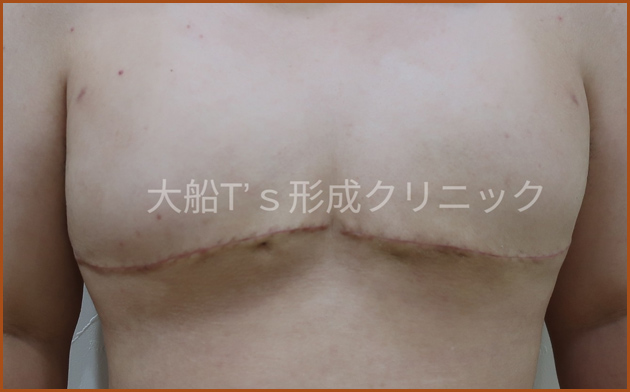 乳房術後1
