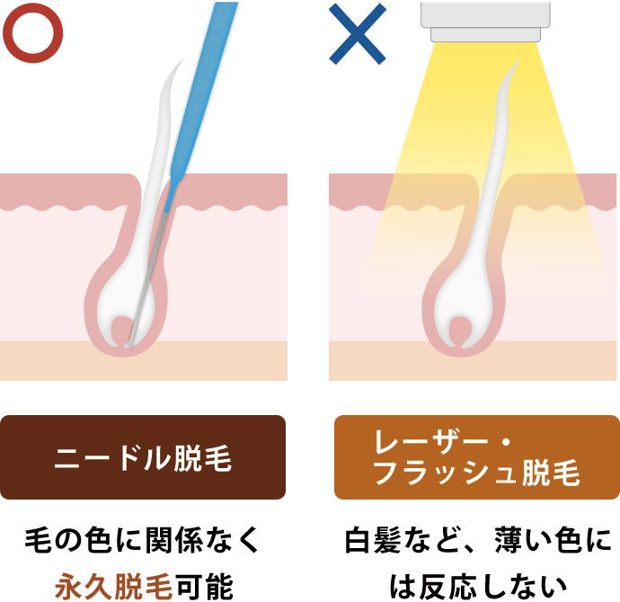 ニードル脱毛は永久脱毛可能