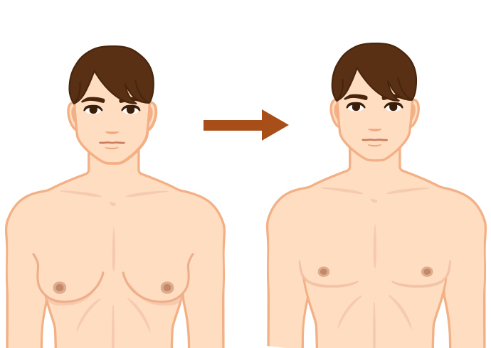 男性らしいナチュラルな胸を形成する治療